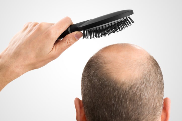 Alopecia