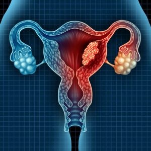 Las causas del cáncer de útero son desconocidas. Se puede decir que al igual que otros tumores, puede ser consecuencia de una serie de alteraciones genéticas que dan lugar a un crecimiento anormal descontrolado.