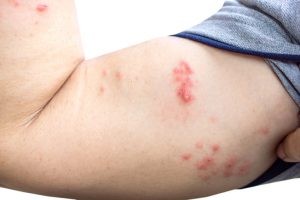 La causa del herpes zóster es haber padecido una infección por varicela, cuyo virus queda latente en el organismo.