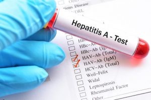 La hepatitis A es el tipo de hepatitis más leve, la cual no suele ser mortal ni producir fallo hepático crónico.