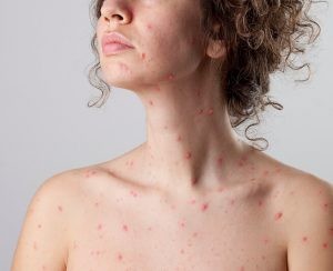 Casi todos los niños han pasado la varicela, pero si no se ha tenido en la infancia, puede afectar a adultos jóvenes y entonces es más virulenta y puede complicarse.