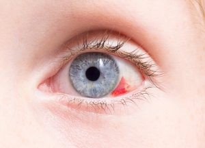 Un día, te miras al espejo y, sin haber notado nada raro, observas que tienes una hemorragia ocular… Seguramente te preguntarás: ¿es grave?.