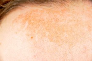 Aunque es menos evidente, también podemos ver pigmentación tipo melasma en hombres, sobre todo si son personas de piel muy morena y muy expuesta al sol