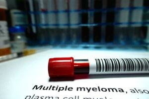 El diagnóstico inicial del mieloma múltiple puede ser casual al ver alteraciones en la analítica de sangre, especialmente la presencia de una paraproteína en ella.