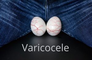 El varicocele va a ser tratado y controlado por el urólogo, quien indicará la conveniencia o no de operar el proceso.