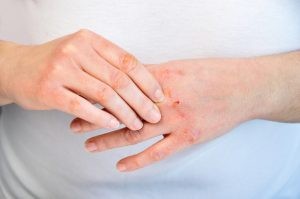 Dermatitis o eccema son palabras que denotan un proceso inflamatorio de la piel caracterizado por picor, erupciones en vesículas o ampollas y descamación.