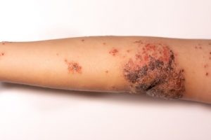 Se trata de una infección superficial de la piel, frecuente en niños, pero que también verse en personas mayores con defensas bajas (inmunodepresión), aunque es más raro.