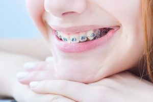 Debemos tener en cuenta que la ortodoncia completa puede requerir entre seis y treinta meses para finalizar.