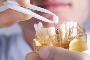 Como ya sabemos el implante colocado en la boca hace la función de una raíz dental fisiológica. Es decir, sostiene o aloja a la corona protésica dental.
