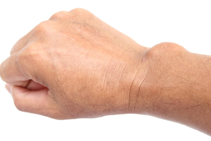 Quiste Epidermoide