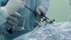 La cirugía mediante laparoscopia pretende evitar una incisión mayor en la pared del abdomen.