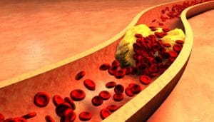 el colesterol alto se descubre en una analítica ocasional que se realiza al paciente, que incluya  bioquímica sanguínea.