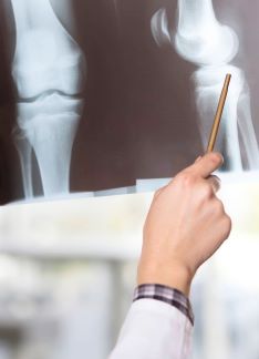 Radiografía de rodilla: ¿por qué se hace?