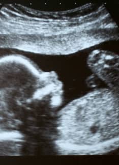 Gastrosquisis fetal: diagnóstico prenatal