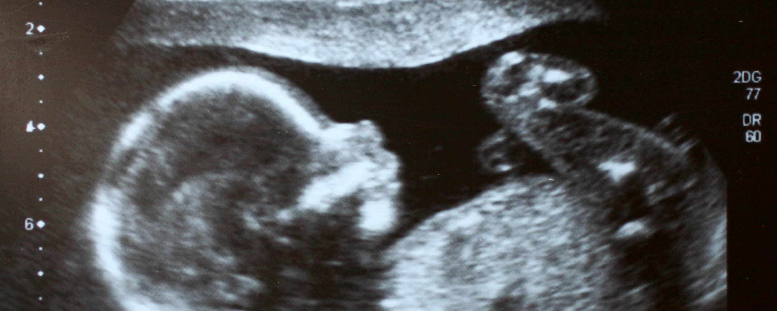 Gastrosquisis fetal: diagnóstico prenatal