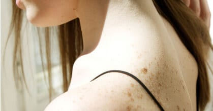 Cómo afecta el verano a enfermedades dermatológicas como rosácea, psoriasis o acné
