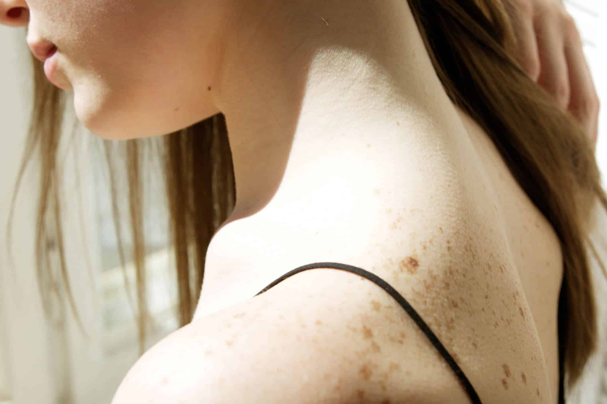 Cómo afecta el verano a enfermedades dermatológicas como rosácea, psoriasis o acné